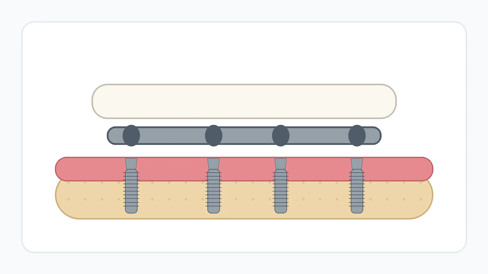 Titanium reinforcing bar positioned between dental implants and a full-arch bridge.